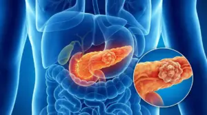 Illustrazione del pancreas con massa tumorale evidenziata nell’addome, vista anatomica del sistema digestivo